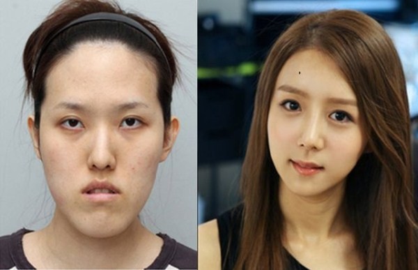 We're featuring several before and after shots of those individuals who have opted to have plastic / cosmetic surgery. Do you believe these cosmetic enhancements have improved the patient's original appearance?