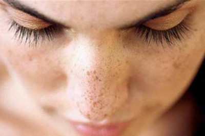 Cilt Lekelerinden Lazer İle Kurtulun