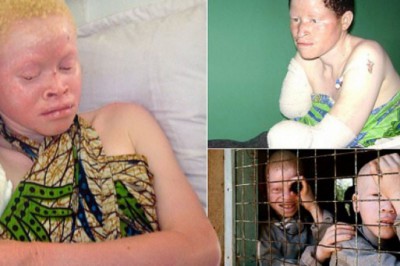 Albino saldırıları arttı: Çoğu çocuk öldürüldü