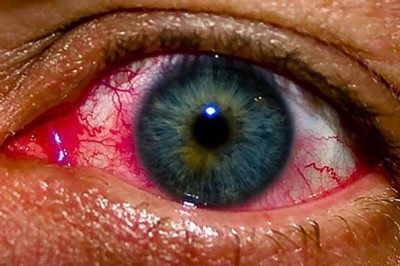 Havuzda gözleri kıpkırmızı yapan klor değil!