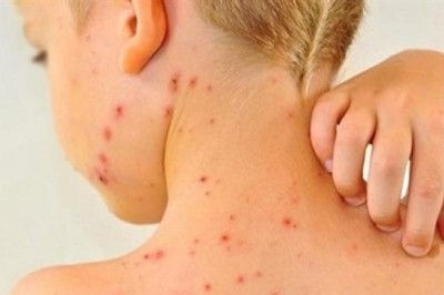 Kızamık Aşısı ve Yan Etkileri