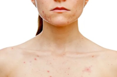 Su Çiçeği Olanlar Nasıl Beslenmeli?